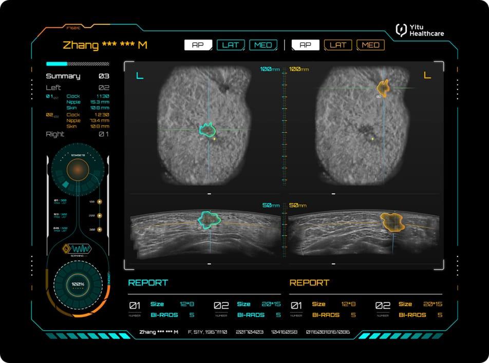 care.aiTM 乳腺超聲智能診斷系統